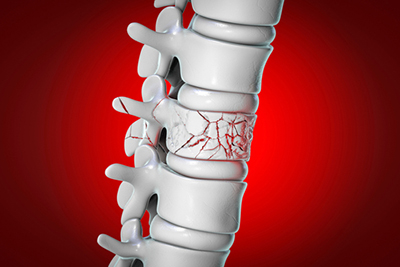 Medical illustration showing a spinal compression fracture requiring kyphoplasty treatment.